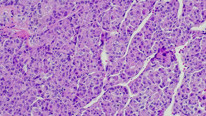 Sarcoma Management: Case-Based Discussion