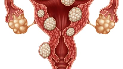 Types and Classifications of Fibroids