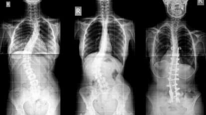 Case Study: Surgical Correction of Adolescent Idiopathic Scoliosis