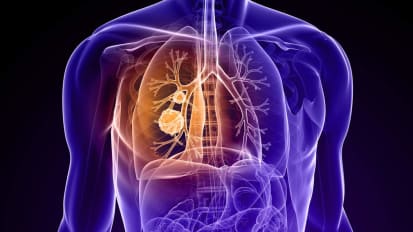 Lung Cancer Surgery - Kimmel Cancer Center Podcast Series