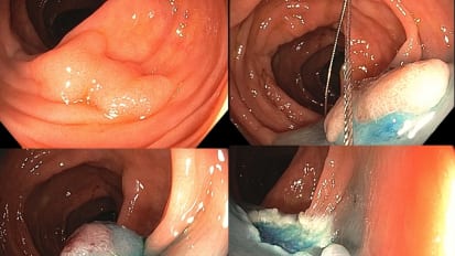 Mastery of Colonoscopic Polypectomy