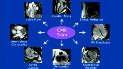 Cardiac MRI: Basic Principles