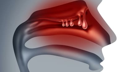 Treating Chronic Rhinosinusitis with Nasal Polyposis (CRSwNP) with Biologic Therapies