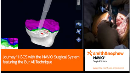 JOURNEY™ II BCS with the NAVIO Surgical System featuring the Bur All Technique