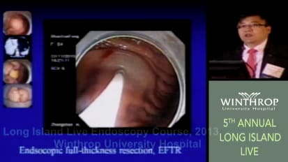 ESD, EFTR & STER: Endoscopic Surgery for Mucosal Neoplasms and Subepithelial Tumors