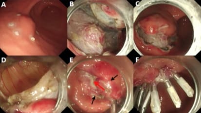 EFTR with Mucosal Preservation to Facilitate Closure