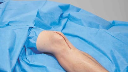 Infection Prevention & Management in Joint Replacements
