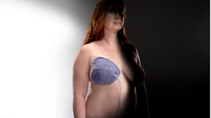Incision and Surrounding Soft Tissue Management: Enhancing the Care Regimen in Breast Surgery