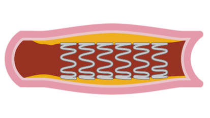 Simple Stent Optimization protocol using IVUS from Dr. Jimmy Kerrigan