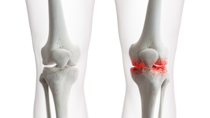 Knee Osteoarthritis Clinical Trial