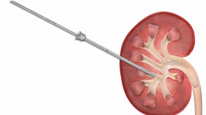 Minimally Invasive PCNL Technique and Demo