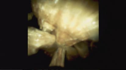 Successful Use of the SpyGlass™ DS System in Treating Mirizzi Syndrome, by Vladimir Kushnir, MD, Washington University, St. Louis, MO, U.S.A.