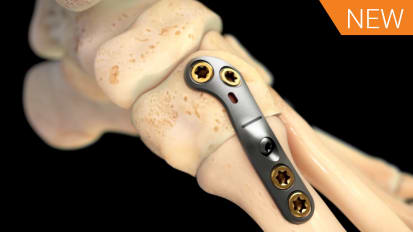 Lapidus Arthrodesis Animation featuring ORTHOLOC™ 2 CROSSCHECK™ [016677A]