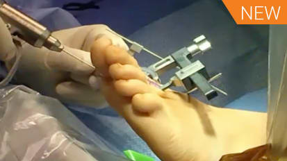 LapiFuse™: Finding a Better Way to Bunion Correction with Dr. Jeremy McCormick [AP-013821A]