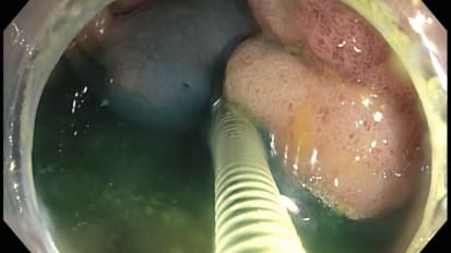 Use of a Double Balloon Endoscopic Platform to Facilitation en bloc EMR