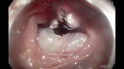 Use of DiLumen™ Double Balloon System to Facilitate Dissection and Defect Closure during Colonic ESD