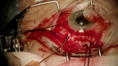 Baerveldt drainage device insertion for refractory glaucoma