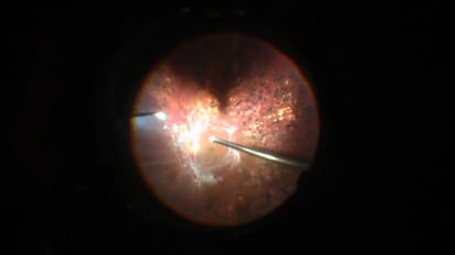 Vitrectomy with a pars plana 25-gauge system