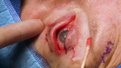 2nd stage of upper eyelid reconstruction with Cutler-Beard flap