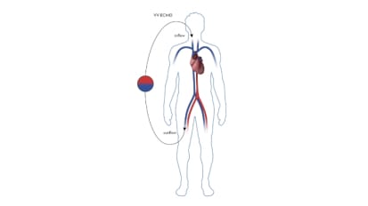 Latest Developments in Extracorporeal Membrane Oxygenation