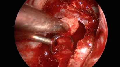 Endoscopic Endonasal Resection of Pituitary Tumors