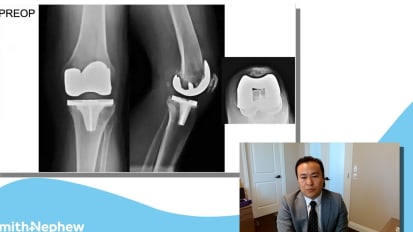 Robotic Assisted Revision Knee