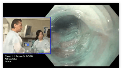 Per Oral Endoscopic Myotomy for Achalasia