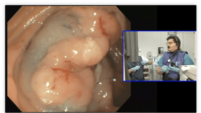 Ampullectomy and Duodebak Endoscopic Submucosal Dissection