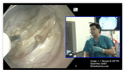 Gastric endoscopic full thickness resection of subepithelial tumor