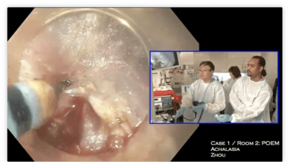 Per Oral Endoscopic Myotomy for Achalasia