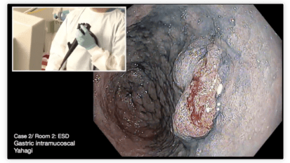 Gastric Endoscopic Submucosal Dissection