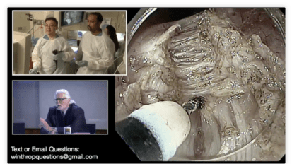 Per Oral Endoscopic Myotomy for Achalasia