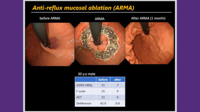 Lecture: Innovations in GERD (ARMA, EPSIS)