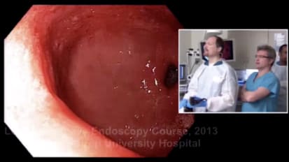 Barrett's Esophagus Evaluaged with Probe-Based Confocal Laser Endomicroscopy and Treatment With EMR or Radiofrequency Ablation