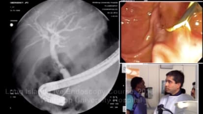 Cholangioscopy Electrohydraulic Lithotripsy of an Impacted CHD Stone