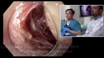 Endoscopic Resection of MP Based Subepithelial Tumor