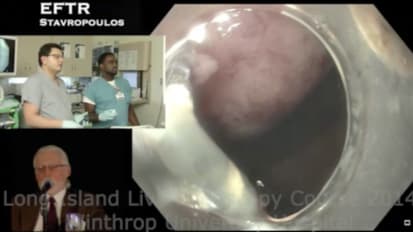 Endoscopic Full Thickness Resection of GIST