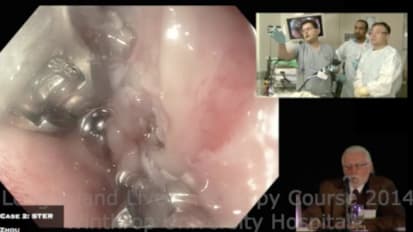 Submucosal Tunnel Endoscopic Resection for Esophageal Submucosal Tumor