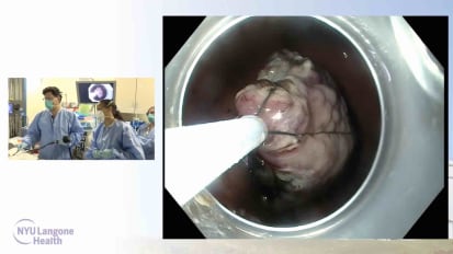  EFTR (4 cm gastric GIST. NOTES excision/sutured closure)