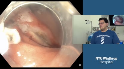 Endoscopic Full-Thickness Resection (EFTR) for Gastric Gastrointestinal Stromal Tumor (GIST)