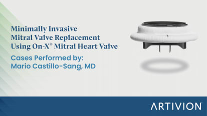 Minimally Invasive Mitral Valve Replacement Using On-X® Mitral Heart Valve Cases 