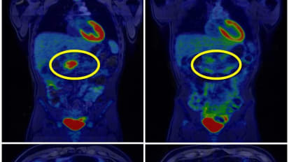 Optimizing outcomes for patients with nonmetastatic pancreatic cancer