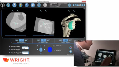 Clinical Use of BLUEPRINT™ on a B3 Glenoid - Parts 1 & 2 - Armodios Hatzidakis, MD [CAW-0508]