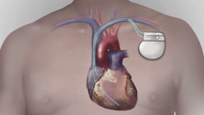 Philips Noninfectious considerations for Lead Management