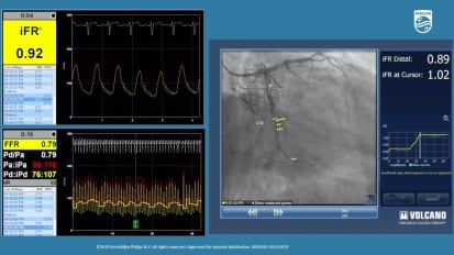 3 vessel disease with iFR Co-registration