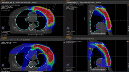 Advances in Radiation Oncology: Proton Therapy for Breast Cancer