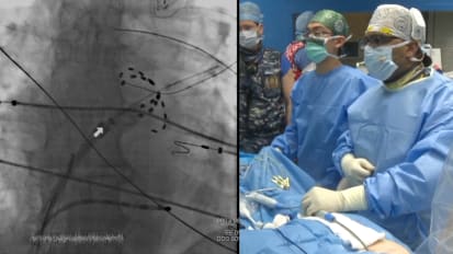 A Recorded Case Presentation of Persistent AF Ablation