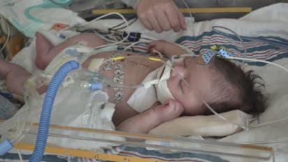 ECMO and a Ross Konno operation saved 6-week old Ruby Munoz