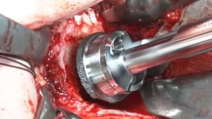 Shoulder Arthroplasty featuring PERFORM REVERSED: Surgical Video - Prof. Markus Scheibel [CAW-8596] 