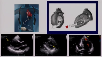 Imaging the Patient with LVAD
